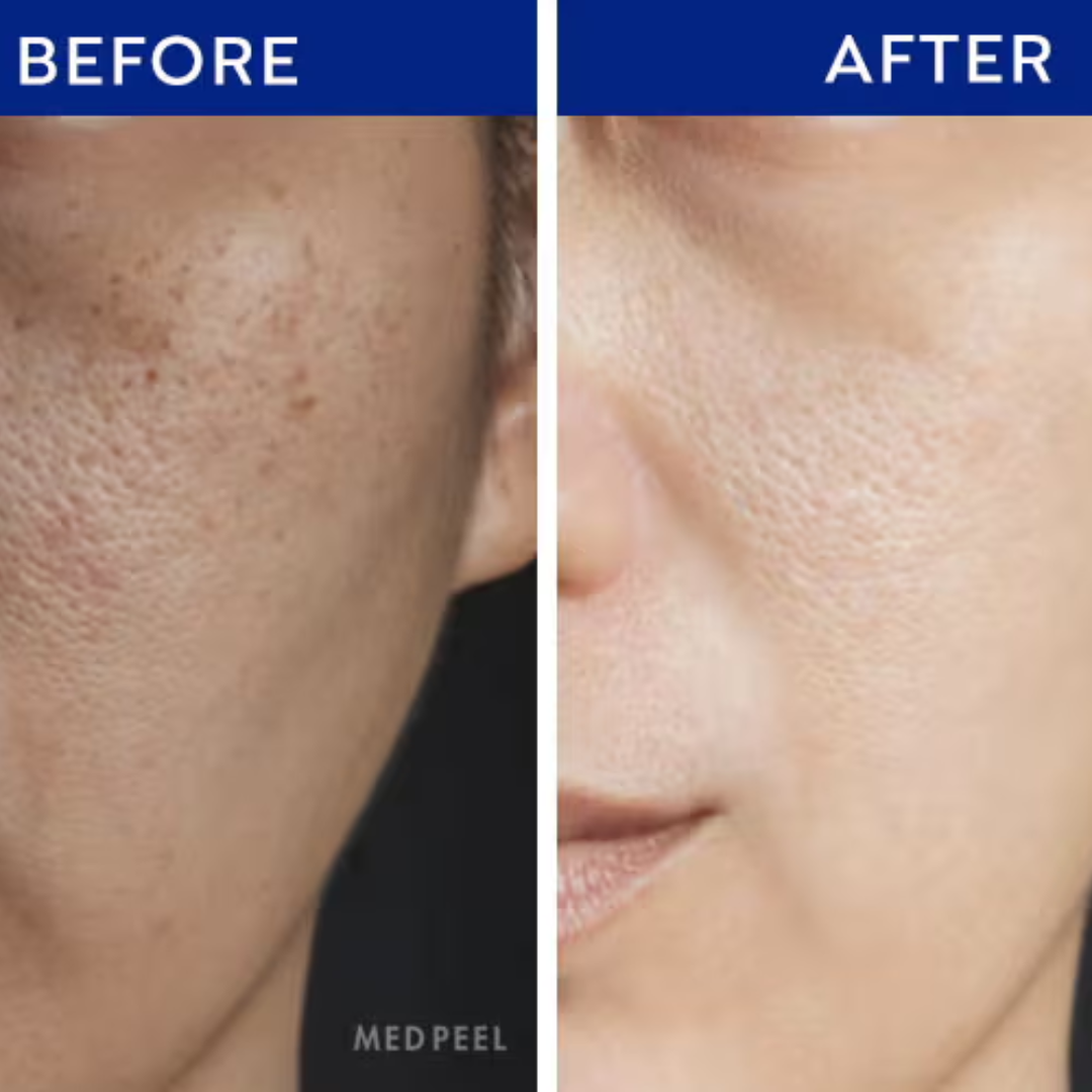 L'Oréal Paris Glycolic Bright Niacinamide Exfoliant Peel | Reduces Pigmentation, Dark Spots & Evens Skin Texture