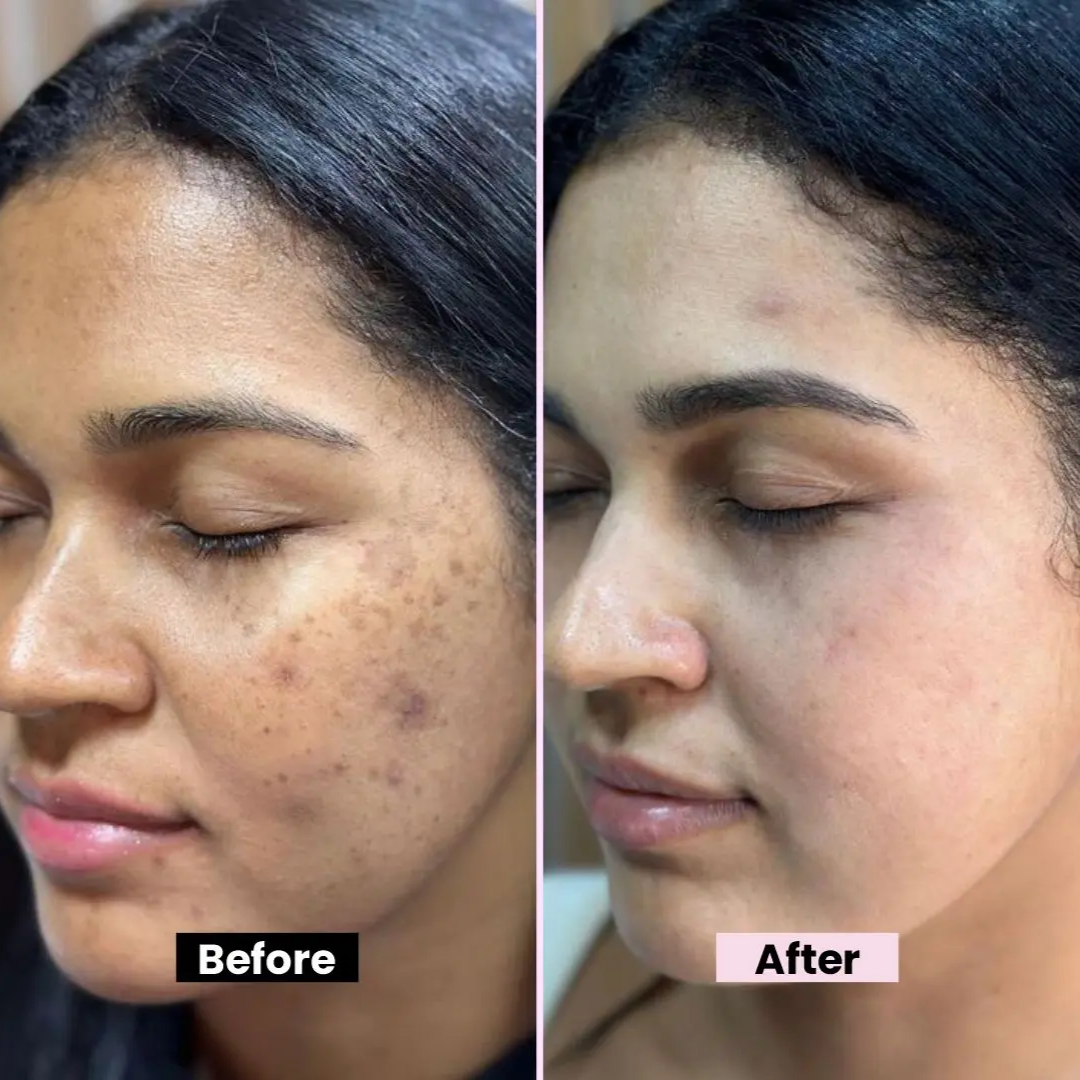 Chalonese Brightening Cream | Fade Pigmentation, Dark Spots & Acne Marks with Niacinamide + Alpha Arbutin