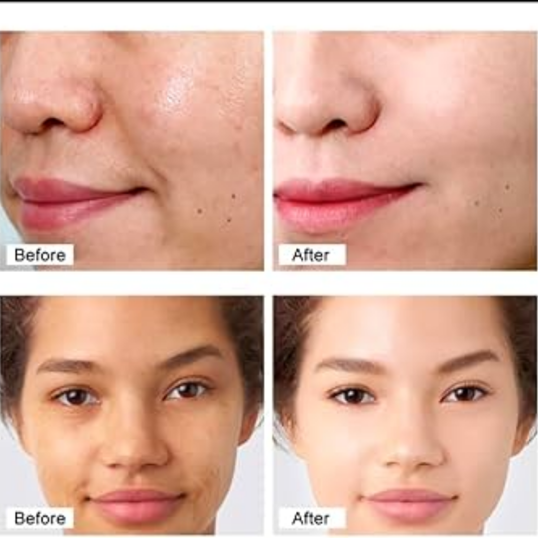 Chalonese Brightening Cream | Fade Pigmentation, Dark Spots & Acne Marks with Niacinamide + Alpha Arbutin