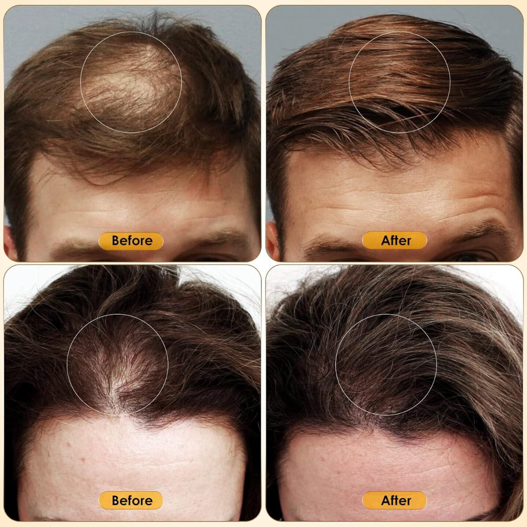 DERMALIST® Rosemary Hair Growth Serum – Reduces Hair Fall, Boosts Density – For All Hair Types