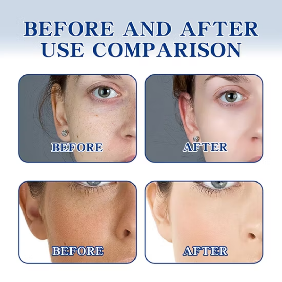 Chalonese Brightening Cream | Fade Pigmentation, Dark Spots & Acne Marks with Niacinamide + Alpha Arbutin