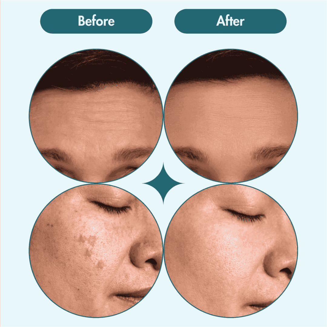 Chalonese Brightening Cream | Fade Pigmentation, Dark Spots & Acne Marks with Niacinamide + Alpha Arbutin