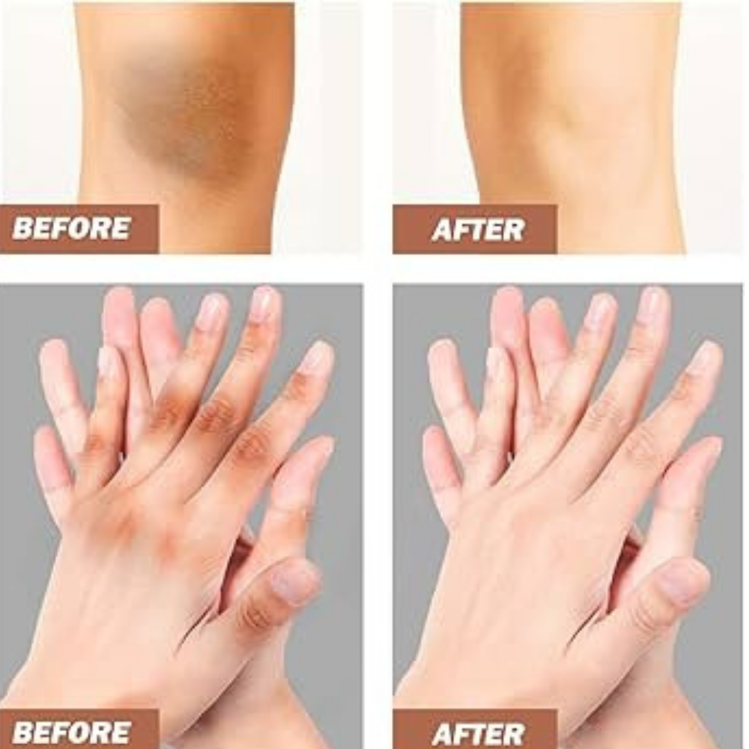 Chalonese Brightening Cream | Fade Pigmentation, Dark Spots & Acne Marks with Niacinamide + Alpha Arbutin